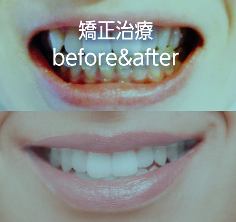 矯正治療before&after