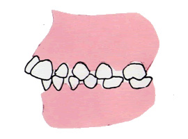 3. 出っ歯