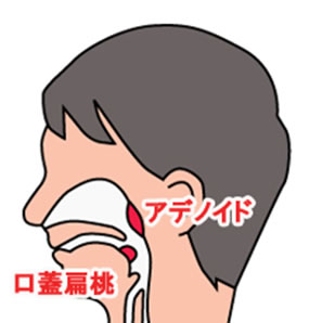 アデノイド（咽頭扁桃）と口蓋扁桃