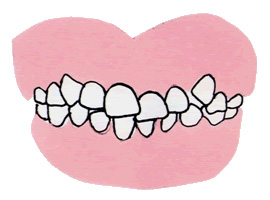 1.歯のデコボコ（叢生：そうせい　歯の重なりや不揃い）
