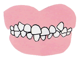 歯のデコボコ（叢生：そうせい　歯の重なりや不揃い）